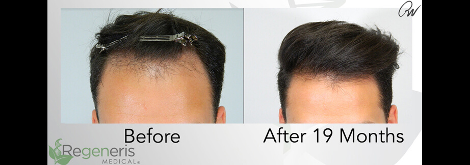 Hair Restoration Using Procell Stem Cell Microneedling